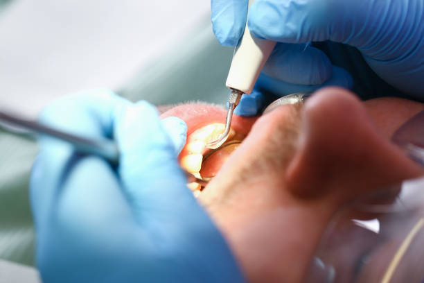 Best Emergency Root Canal Treatment in Cheval, FL